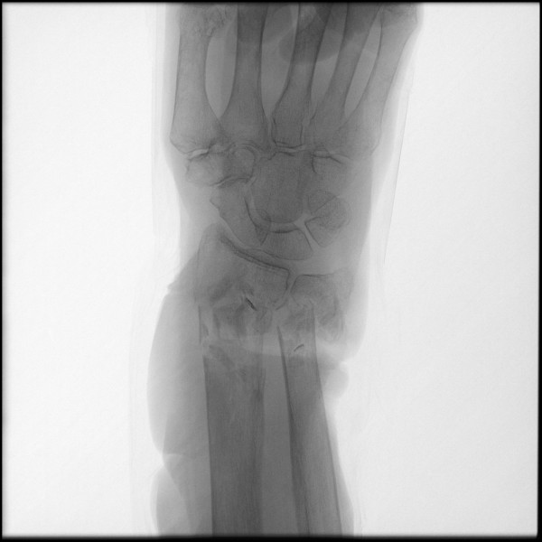 Fracture of Distal Radius/Ulna - Right