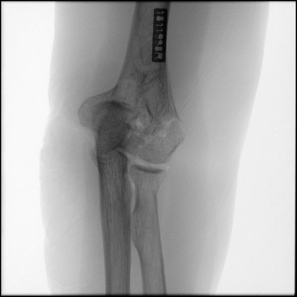Fracture of Distal Humerus - Left
