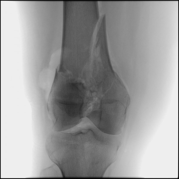 Fracture of Distal Femur - Right