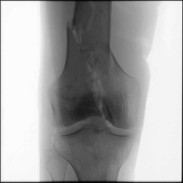 Fracture of Distal Femur - Right