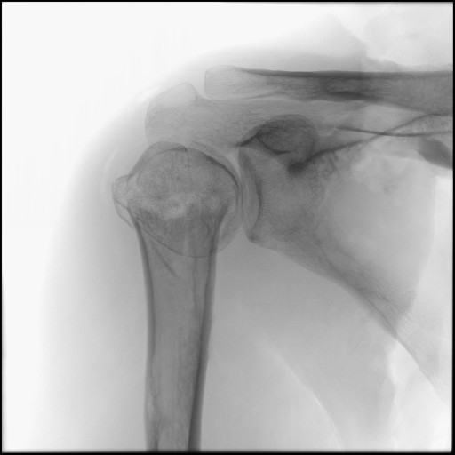 Fracture of Proximal Humerus - Right