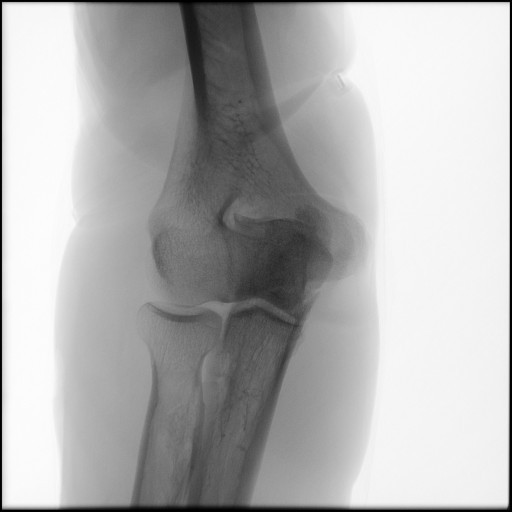 Fracture of Proximal Ulna - Right