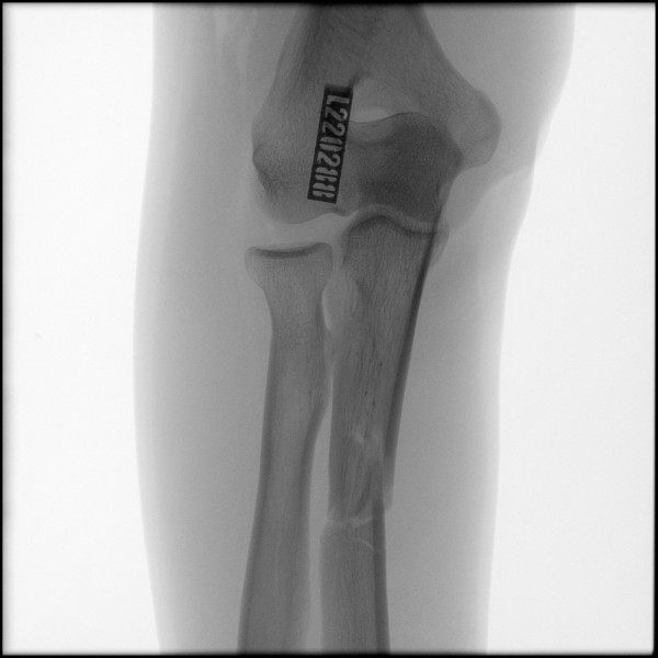 Fracture of Proximal Ulna - Right