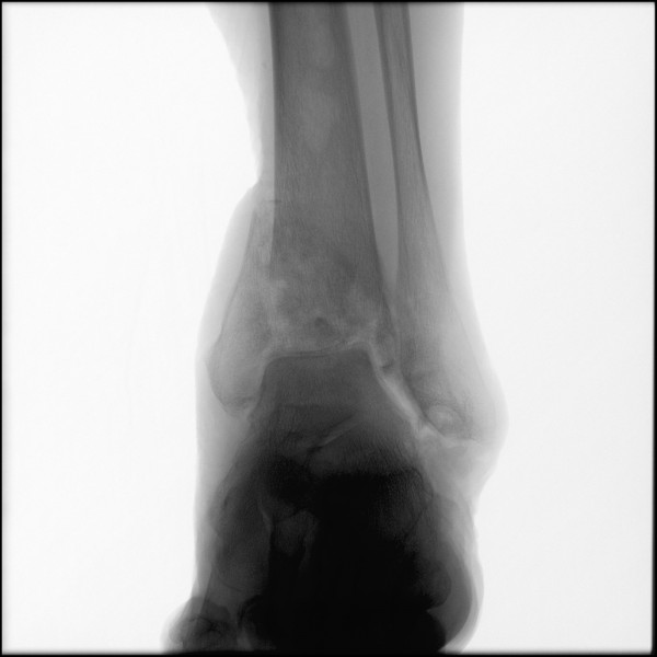 Fracture of Distal Tibia - Left