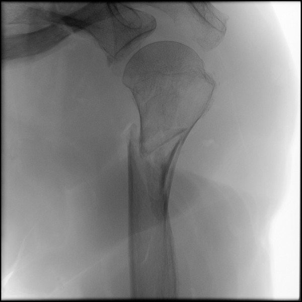 Fracture of Proximal Humerus - Left