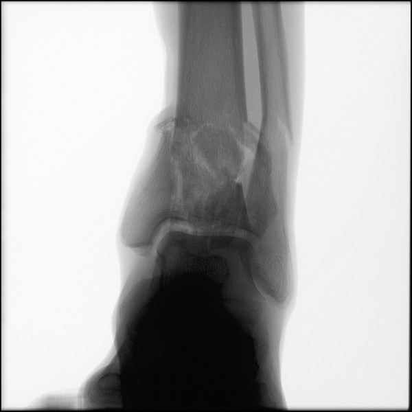 Fracture of Distal Tibia/Fibula - Left