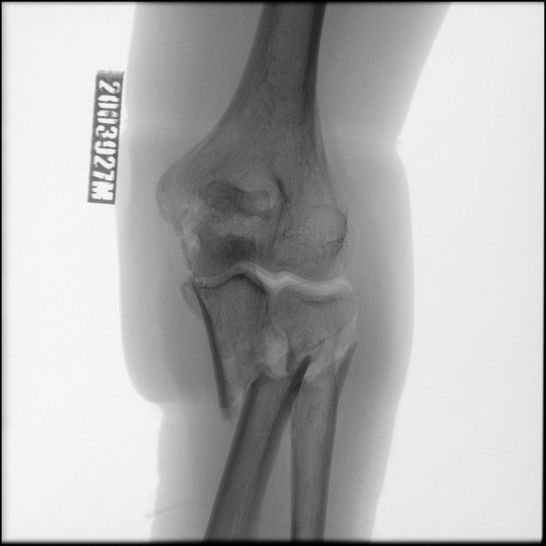 Fracture of Proximal Ulna - Left