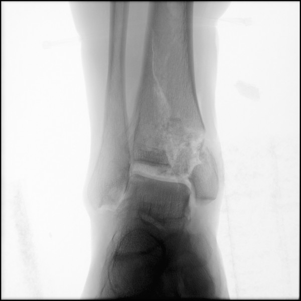 Fracture of Distal Tibia - Right