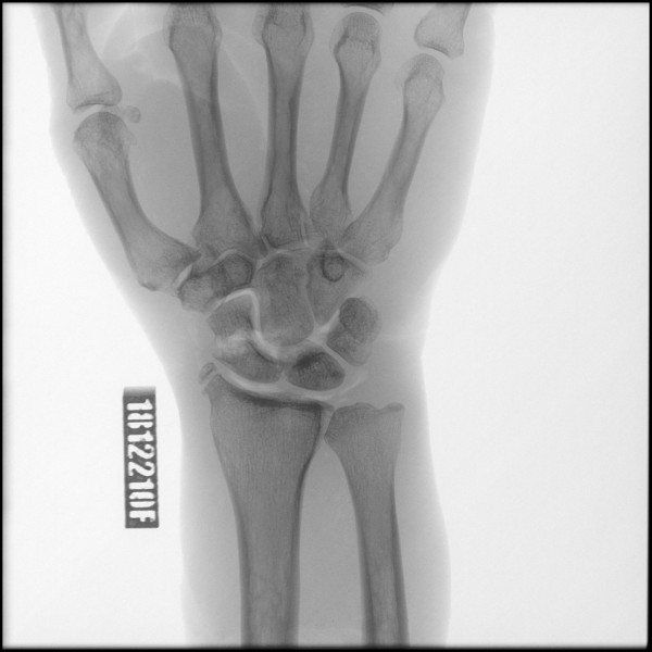 Fracture of Scaphoid - Right