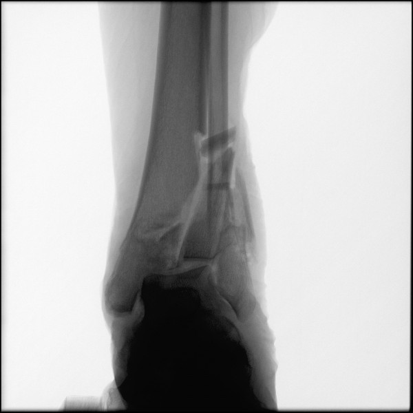 Fracture of Distal Tibia/Fibula - Left