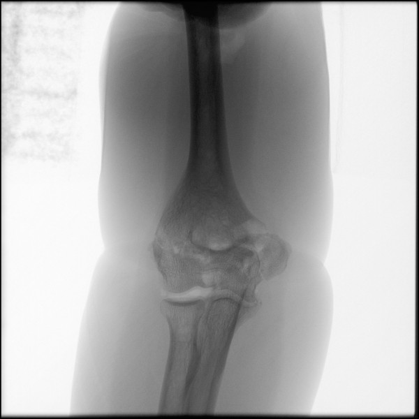 Fracture of Distal Humerus - Right