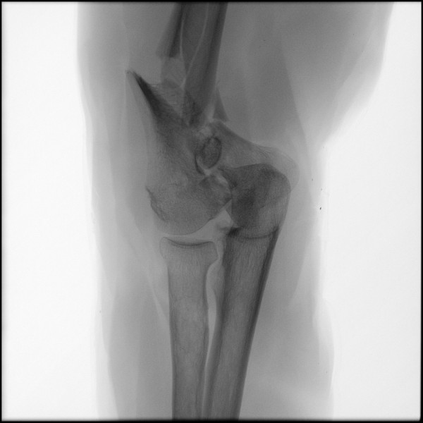 Fracture of Distal Humerus - Right