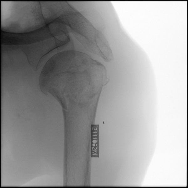 Fracture of Proximal Humerus - Left