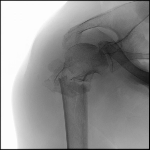 Fracture of Proximal Humerus - Right