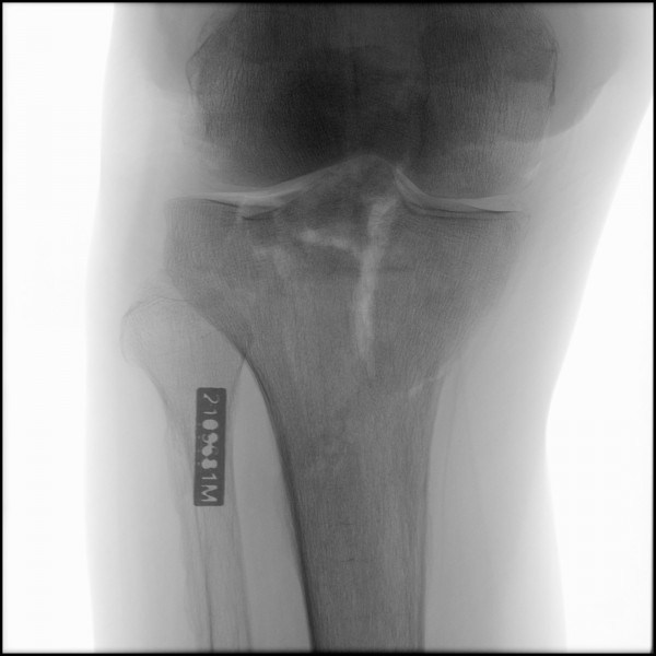 Fracture of Proximal Tibia/Fibula - Right