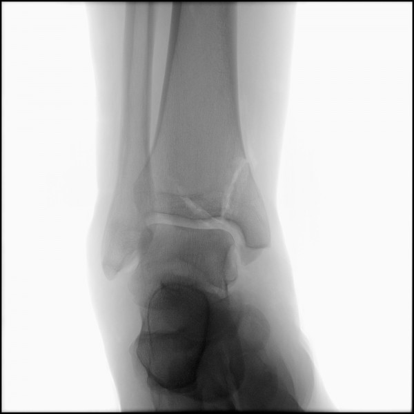 Fracture of Distal Tibia - Right
