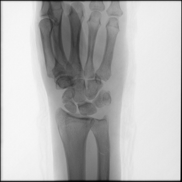 Fracture of Scaphoid - Right