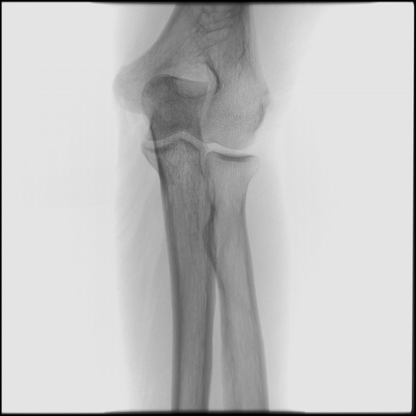 Fracture of Proximal Ulna - Left