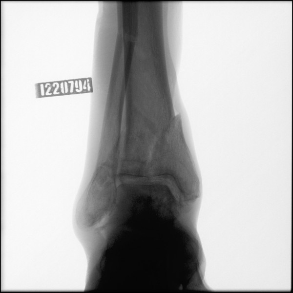 Fracture of Distal Tibia/Fibula - Right